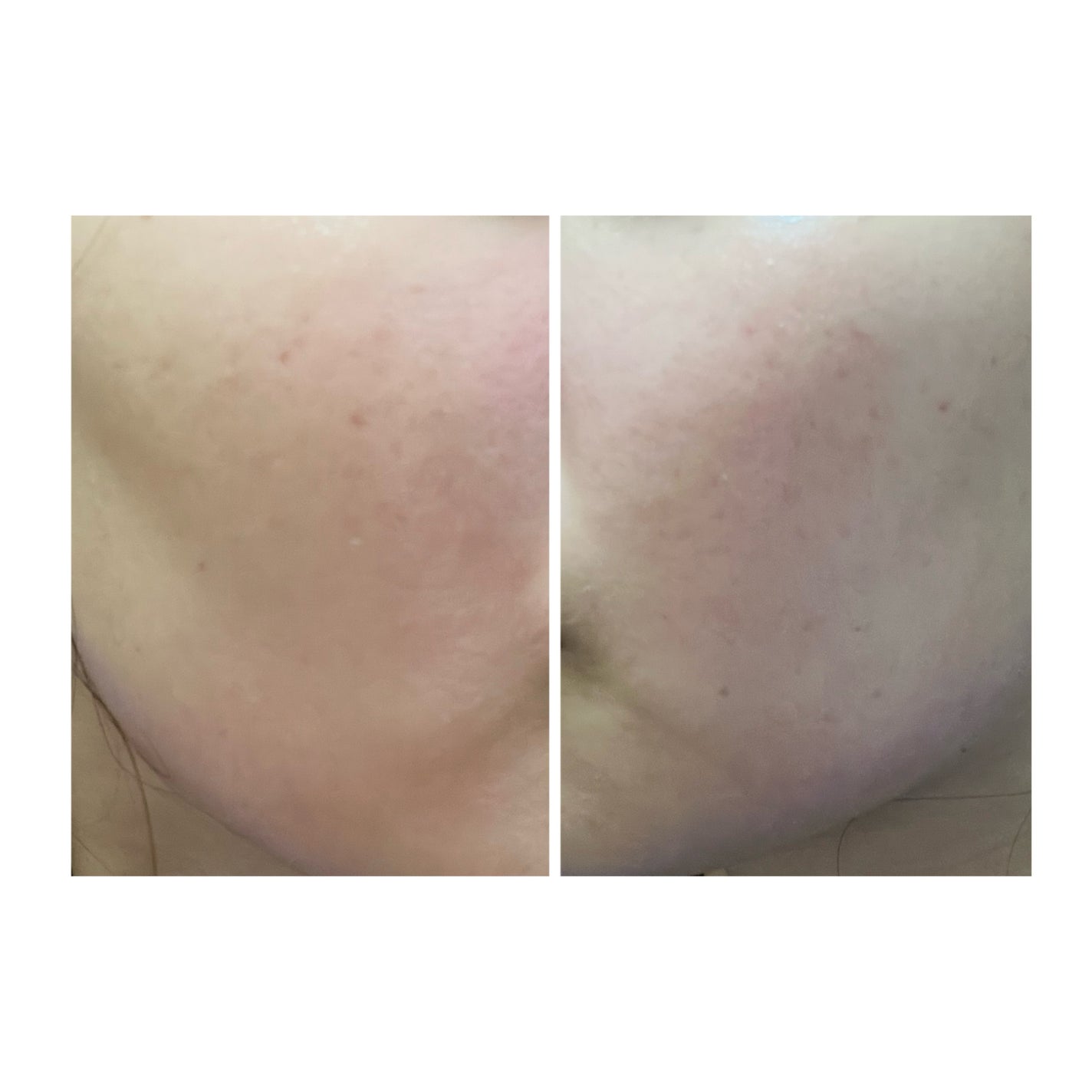 ぽむ on LIPS 「2023.9.13皮膚科に受診 エピデュオとヘパリン処方1枚目..」(4枚目)