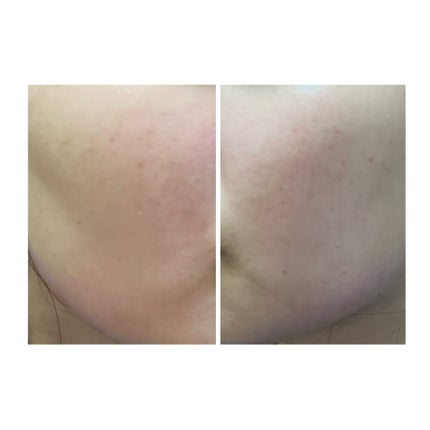 ぽむ on LIPS 「2023.9.13皮膚科に受診 エピデュオとヘパリン処方1枚目..」(4枚目)