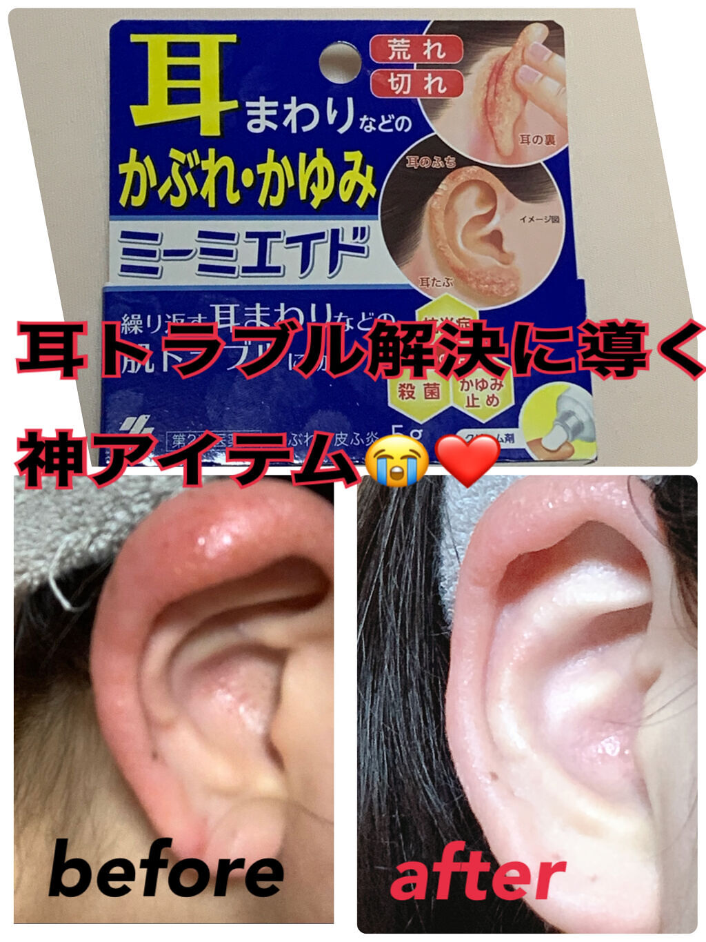 ミーミエイド(医薬品)/小林製薬/その他を使ったクチコミ（1枚目）