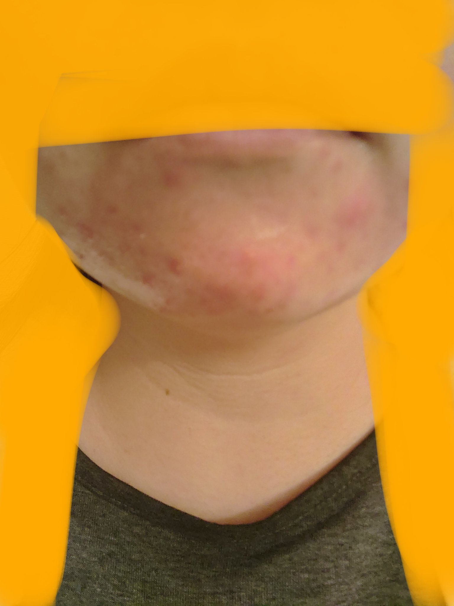 ごめんね素肌 キニナルマスク/クリアターン/シートマスク・パックを使ったクチコミ（3枚目）