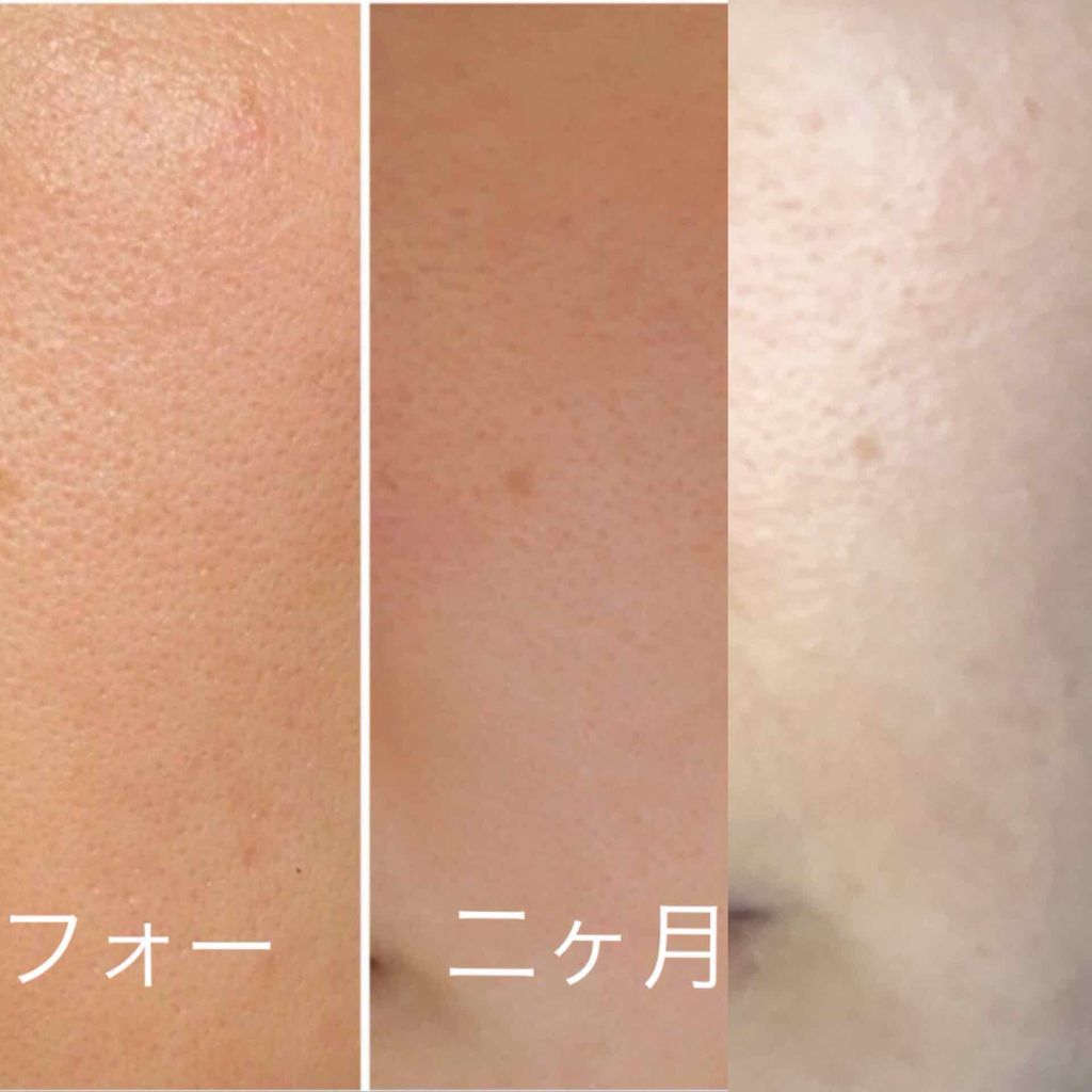 メラノフォーカスV/HAKU/美容液を使ったクチコミ(3枚目)