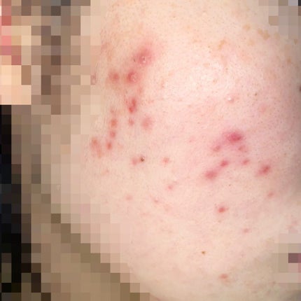 オキシドール(医薬品)/日本薬局方/その他を使ったクチコミ(2枚目)