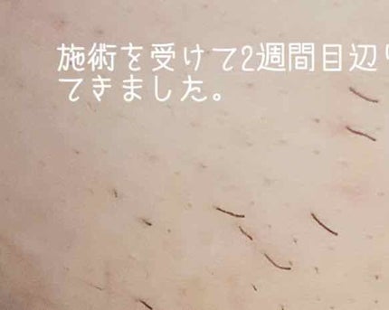 ☆scallop☆フォロバ100%☆ on LIPS 「湘南美容外科クリニック医療脱毛レポート初めて医療脱毛を受けて来..」(4枚目)