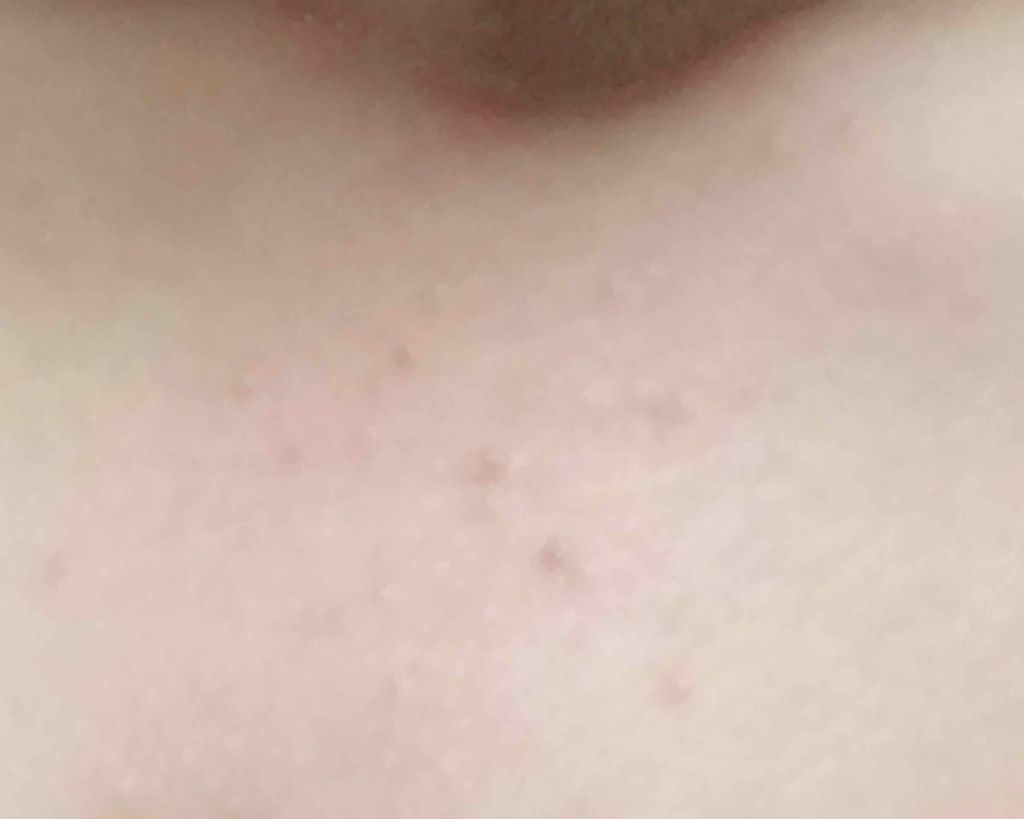 れな on LIPS 「私最近こういうぶつぶつに悩まされてるんです৲(˃੭̴˂)৴この..」(2枚目)