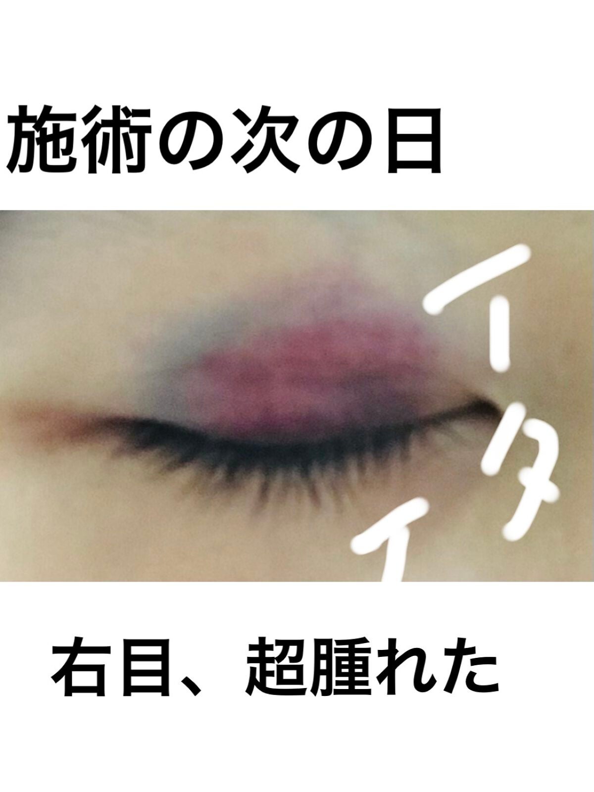 べあ@sjk on LIPS 「春休み真っ只中、整形シーズン!ということで普段投稿あまりしない..」(5枚目)