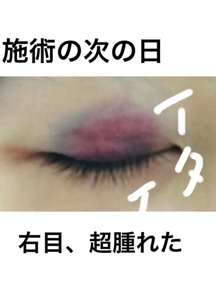 べあ@sjk on LIPS 「春休み真っ只中、整形シーズン!ということで普段投稿あまりしない..」(5枚目)