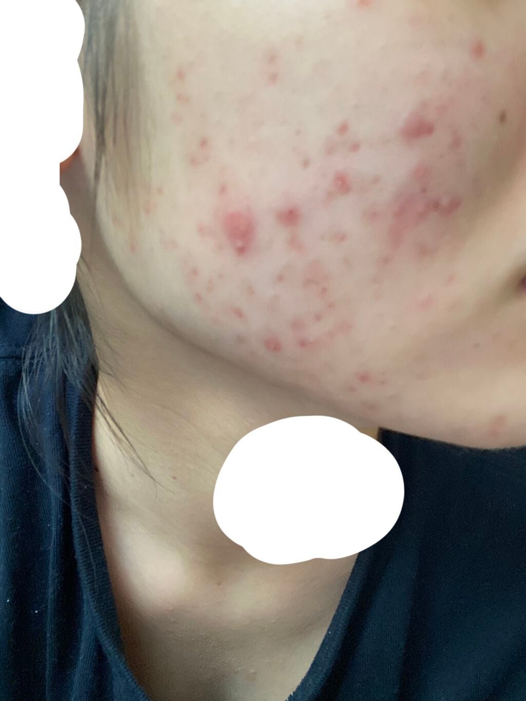 あちもち on LIPS 「⚠️助けてください⚠️ニキビ日記4日目━━━━━━━━━━━━..」(1枚目)