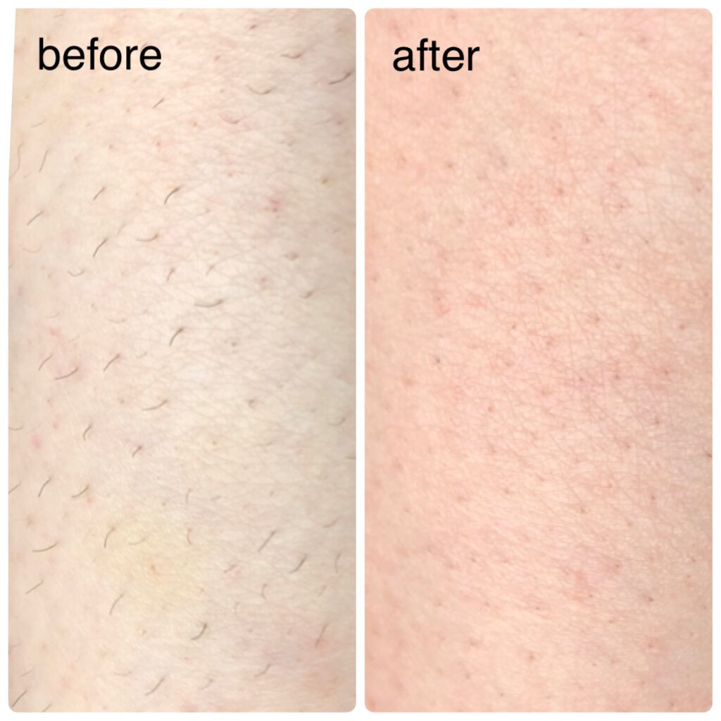 エピリムーバー/TBC/除毛クリームを使ったクチコミ（3枚目）