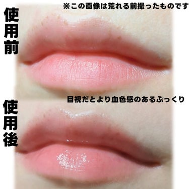 ある日から唇にブツブツが…💦


keybo
DOTOM Lip Plus Plumper
神spring　glass

オリーブオイル、
トウゴマ種子油、
メントール配合
ボルフィリン（脂肪細胞を刺激する成分）が
最大量配合されているそう。


たしかに一時的にふっくらしますが、
とにかく痛いです（笑）

この刺激がわりと癖になって
しばらく愛用していたのですが…


ある日からこれを塗るたびに
唇に小さなブツブツが発生するように💦

私の唇には刺激が強すぎたのかなと。


そして、ペットボトルなどで飲み物を飲んだあと
時間を空けてまた飲むと
舌がピリッと来ることがありました😂


ほんの少量を使用してみても、
やはり最近はブツブツができるので


面白くて好きでしたが
残念ながらリピ無しです🥺


#keybo  #リッププランパー　#プランパー　
#DOTOMLipPlusPlumper #神springglassの画像 その1