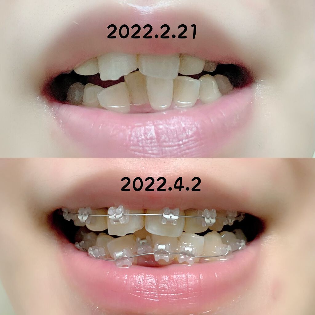 コンクールF/ウエルテック/マウスウォッシュ・スプレーを使ったクチコミ(7枚目)