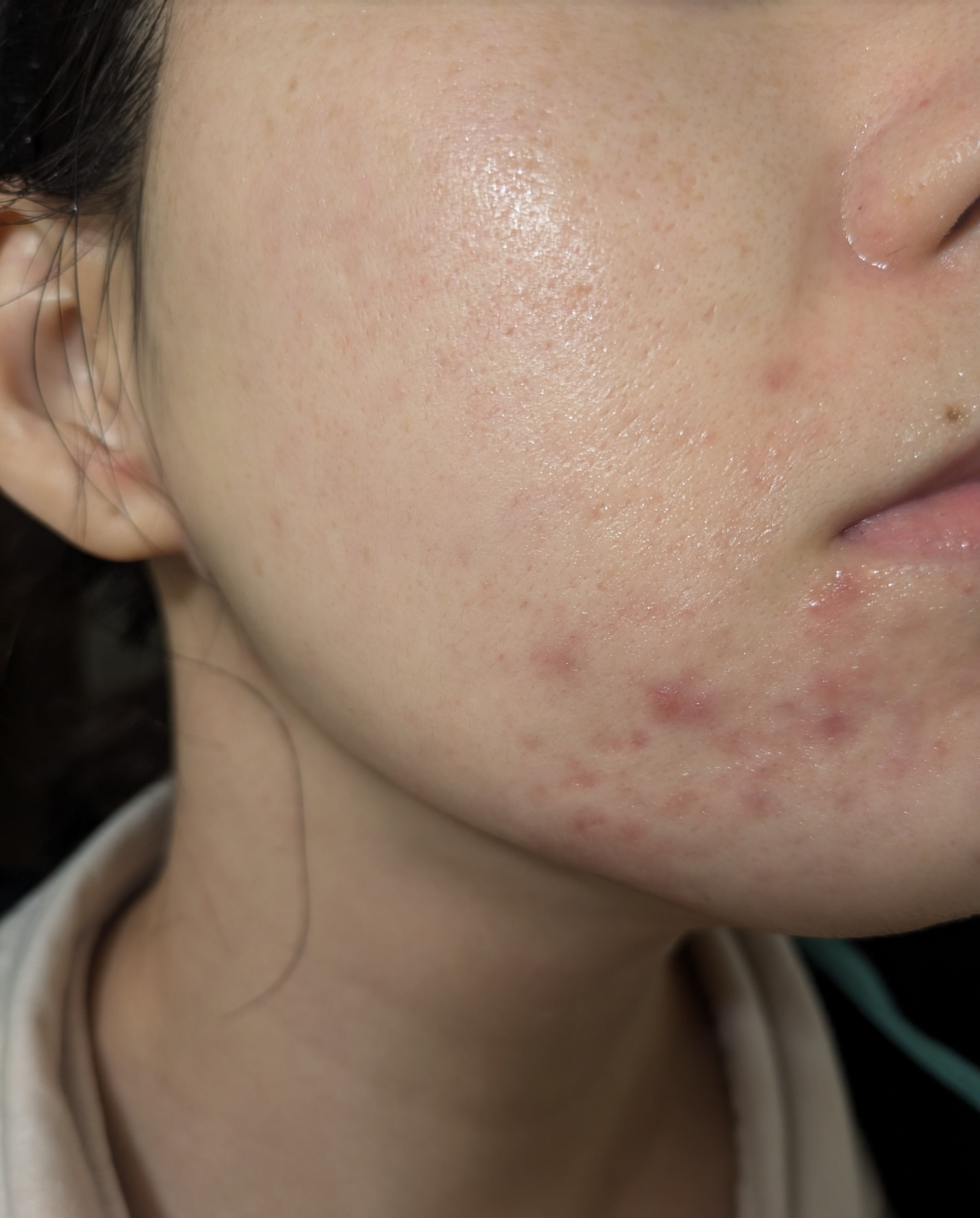 11/12の#汚肌工事録

今見ると変な荒れ方してます😂