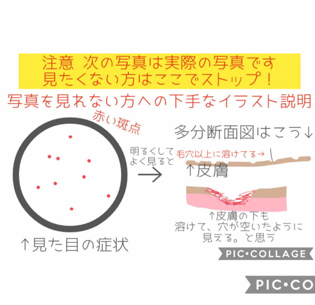除毛クリームキット敏感肌用/エピラット/除毛クリームを使ったクチコミ（2枚目）