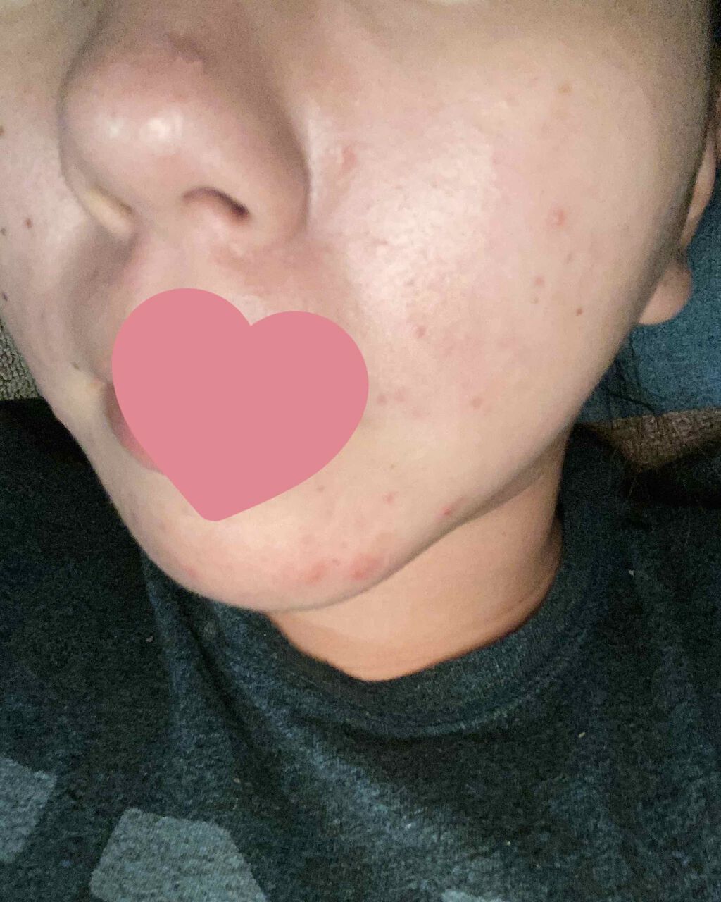 あお on LIPS 「オロナイン日記#6鼻の上のニキビは小さくなって跡、、、???の..」(3枚目)