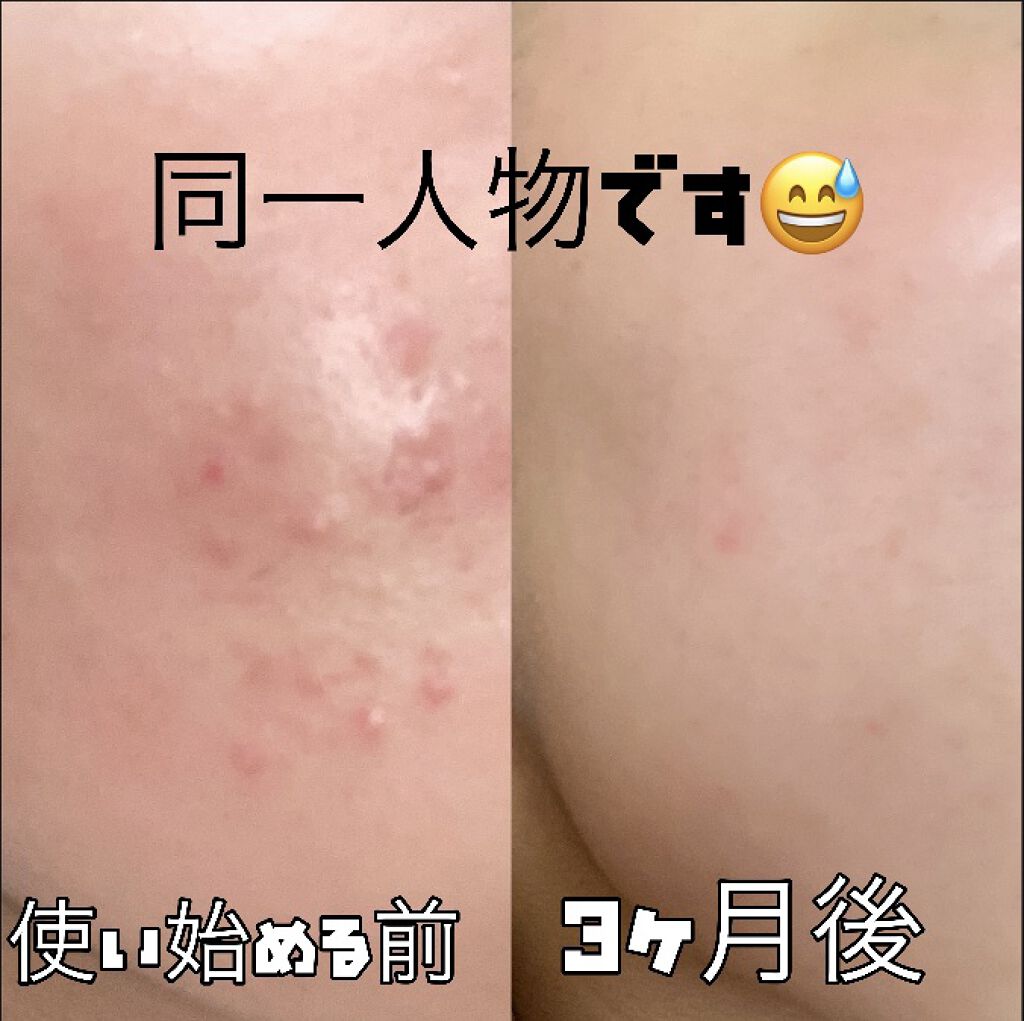 薬用石鹸 ミューズ(固形)/ミューズ/ボディ石鹸を使ったクチコミ（2枚目）