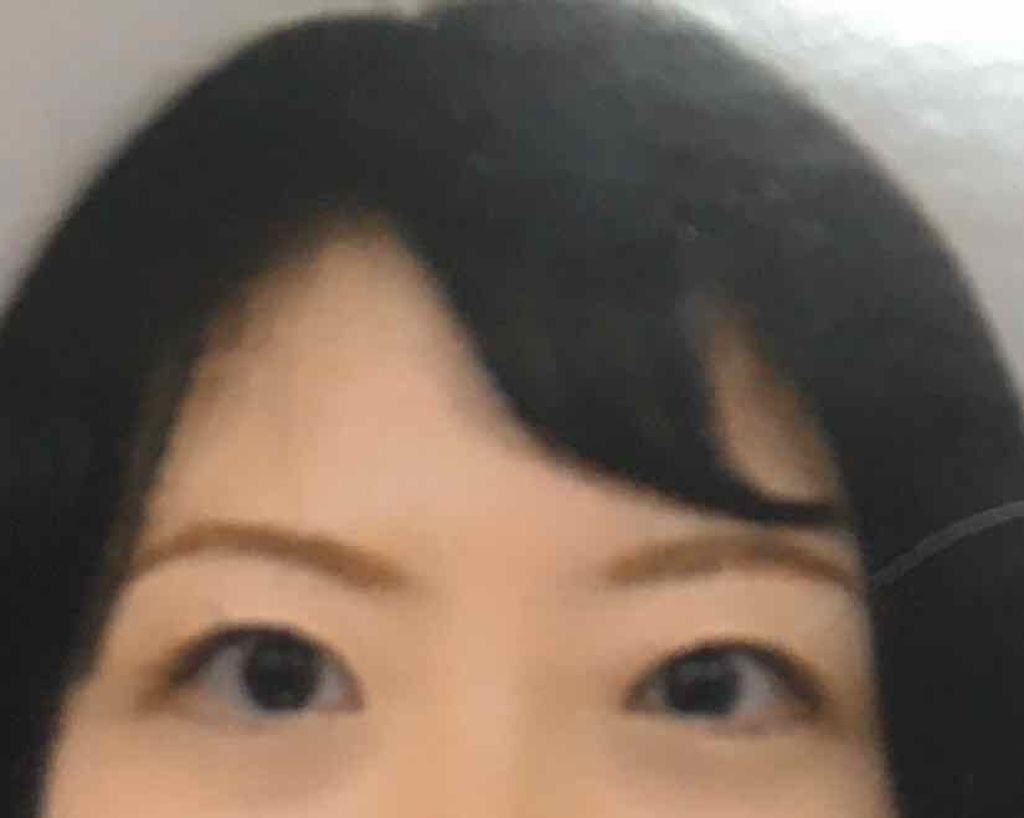 二重整形/その他を使ったクチコミ（2枚目）