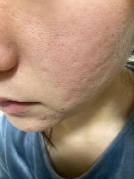 オバジC10セラム/オバジ/美容液を使ったクチコミ(4枚目)