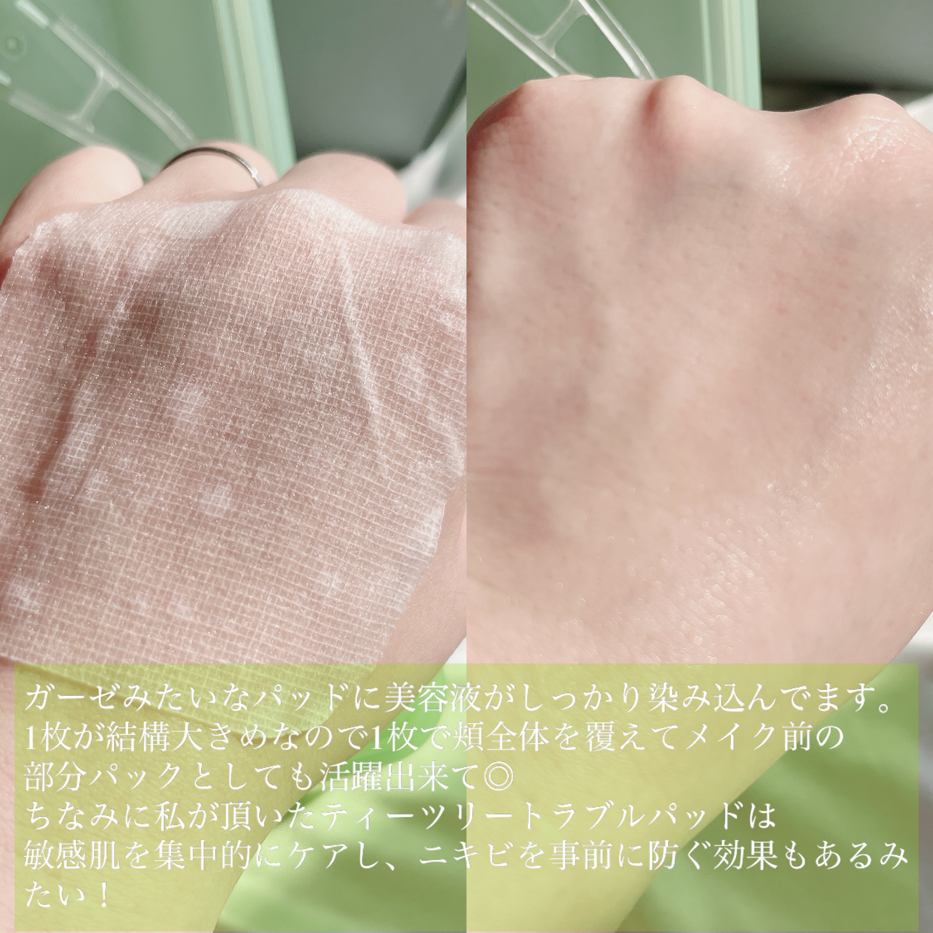 ティーツリー トラブルパッド/MEDIHEAL/トナーパッドを使ったクチコミ（3枚目）