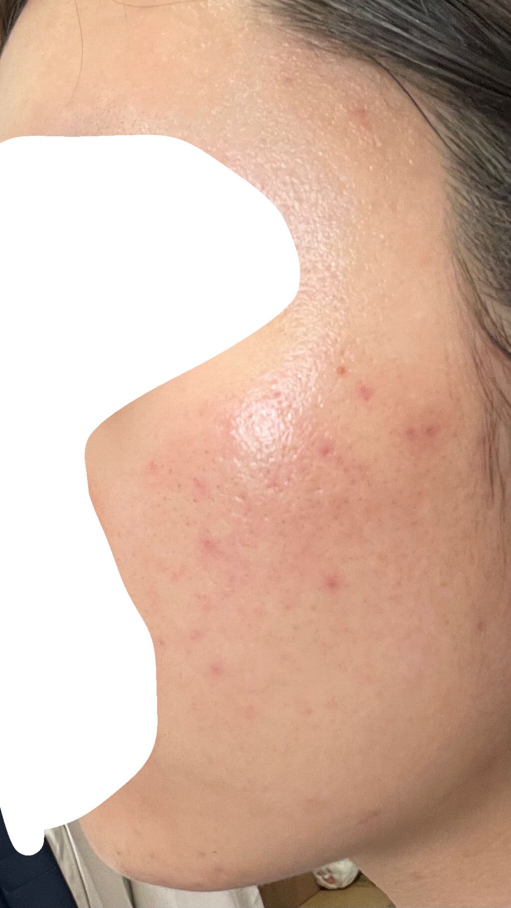 ディフェリンゲル0.1% /マルホ株式会社/その他を使ったクチコミ（2枚目）