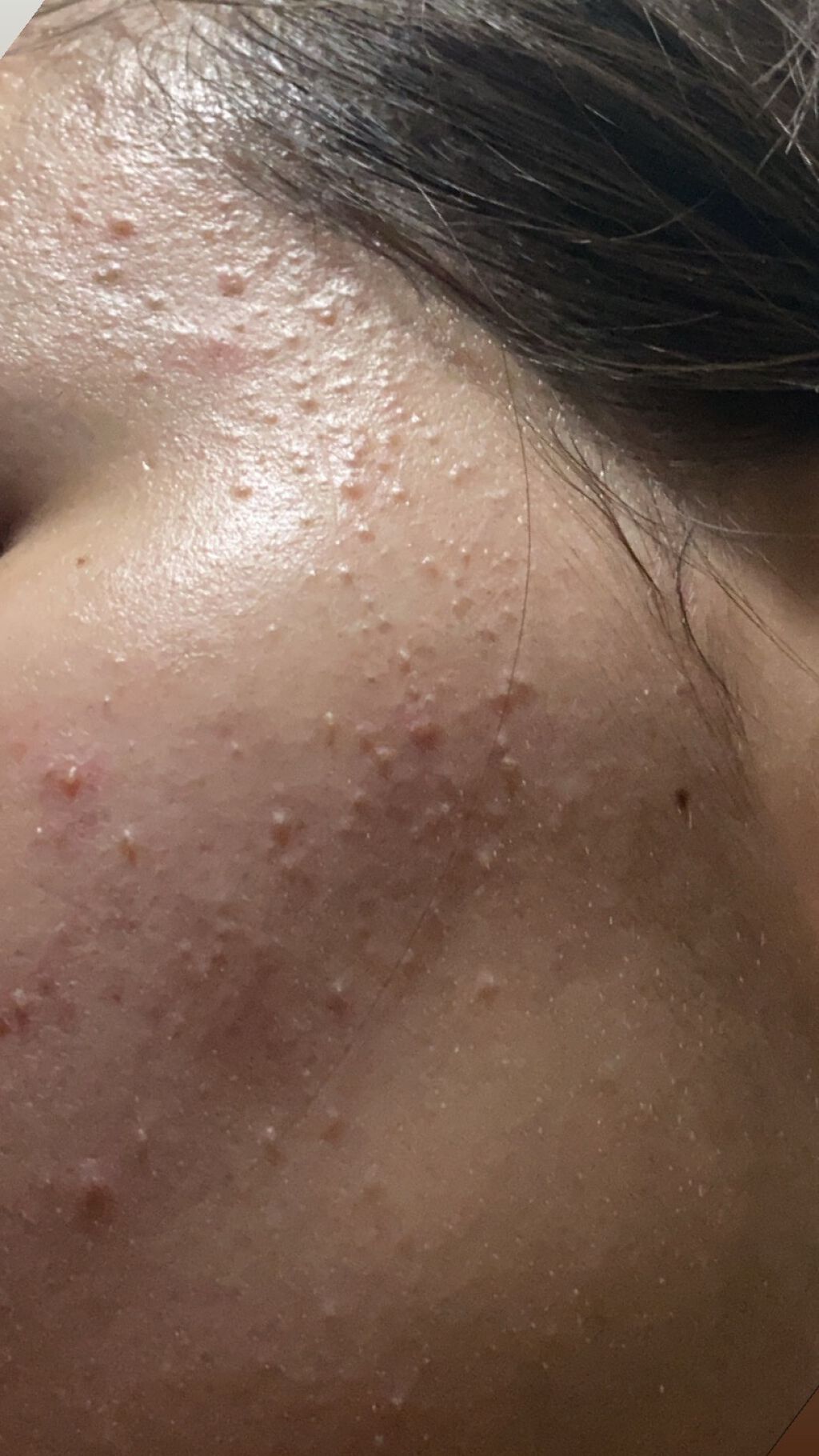 薬用パウダー化粧水/メンソレータム アクネス/化粧水を使ったクチコミ(3枚目)