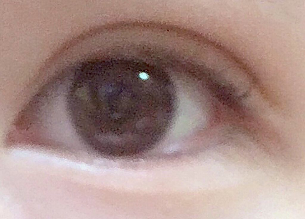 sparkle_perfume_4h3r on LIPS 「1枚目…整形後10日目2枚目…整形前春休みを使って二重整形を受..」(1枚目)