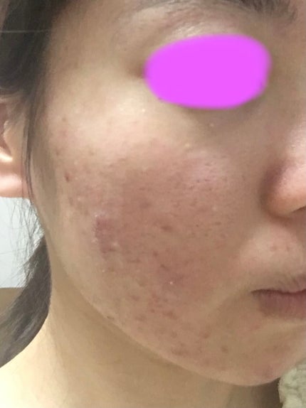 ドクタージャルト シカペアセラム /Dr.Jart+/美容液を使ったクチコミ(3枚目)