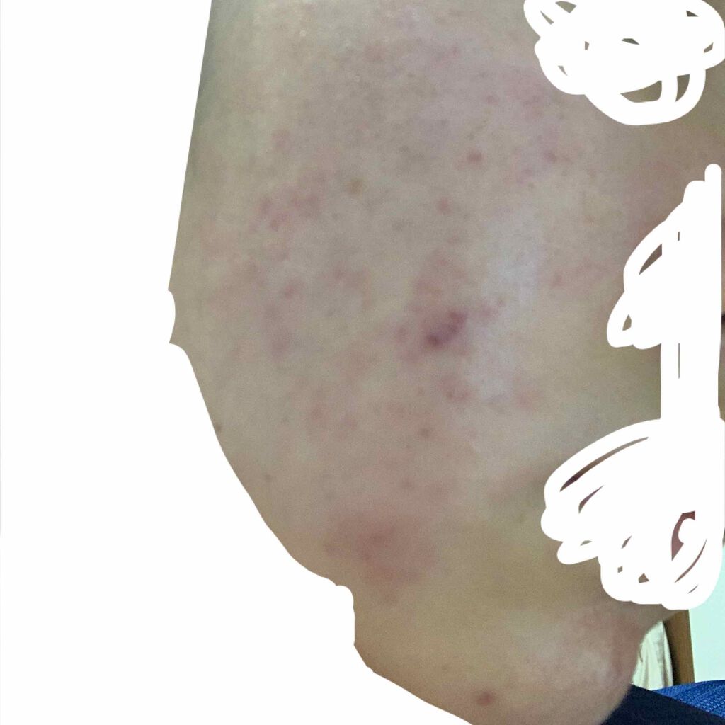 さき on LIPS 「ニキビ、ニキビ跡がすごいです。どうすればいいでしょうか😢また、..」(1枚目)