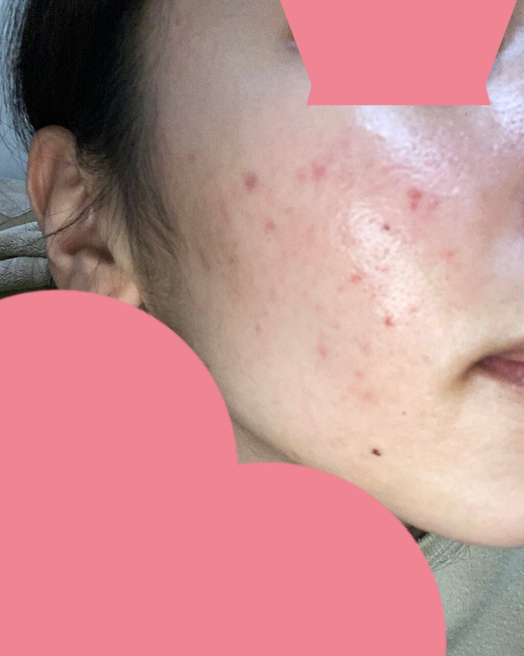 pink_sounds_rrza on LIPS 「べピオゲル1ヶ月経過ニキビはまじでできなくなった、ニキビ跡は前..」(1枚目)