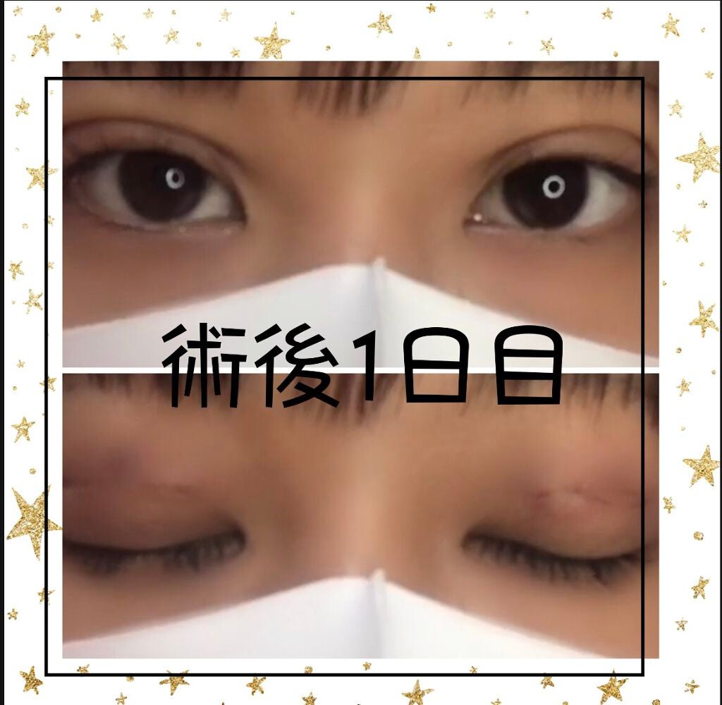 ♡. on LIPS 「実は私、2月5日金曜日に…二重整形してきました👏🏻👏🏻詳しく知..」(3枚目)