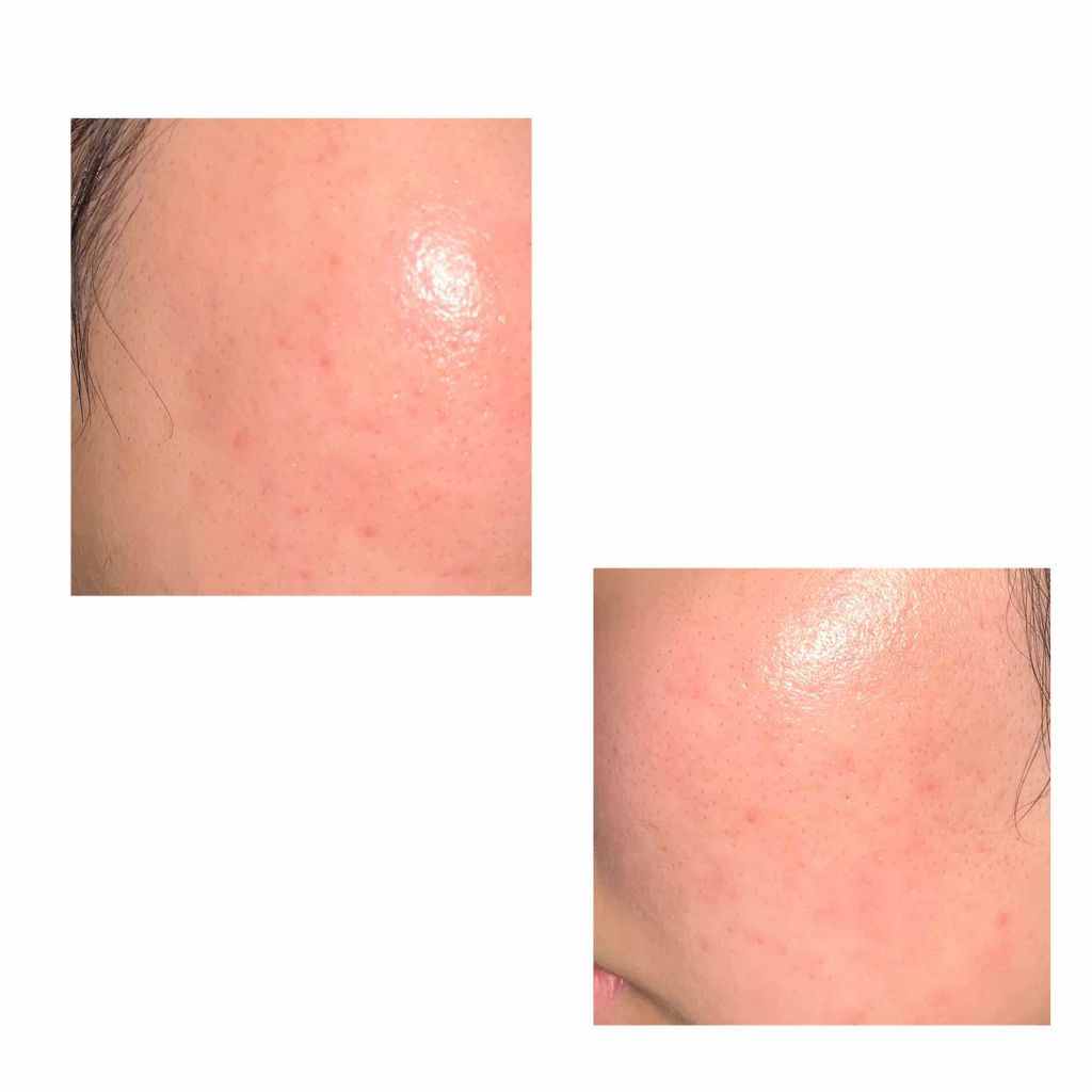 yuu on LIPS 「閲覧注意です二枚目に汚い写真あります。私はこの世で一番肌が汚い..」(2枚目)