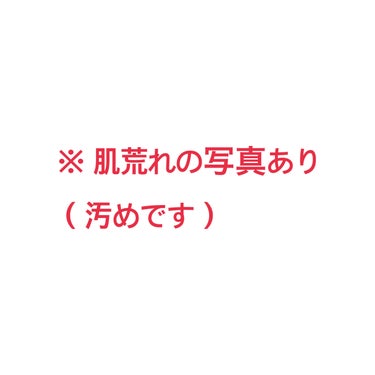 旅行から帰ると顔が酷くなった時があって、思い出したのでﾒﾓﾒﾓ_φ(･_･

秋のことだけど、気温が高く夏みたいだった。
旅行できゃっきゃして、家に帰ると顔が一部赤くなってた（写真一枚目）

なんじゃこ