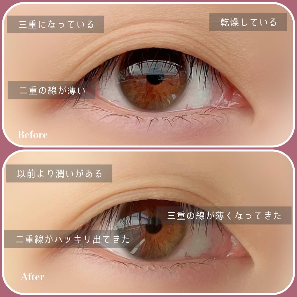 アイキュット マッサージャークリーム Agarismの口コミ 悩んでいた三重から二重に By にゃん汰 混合肌 代後半 Lips