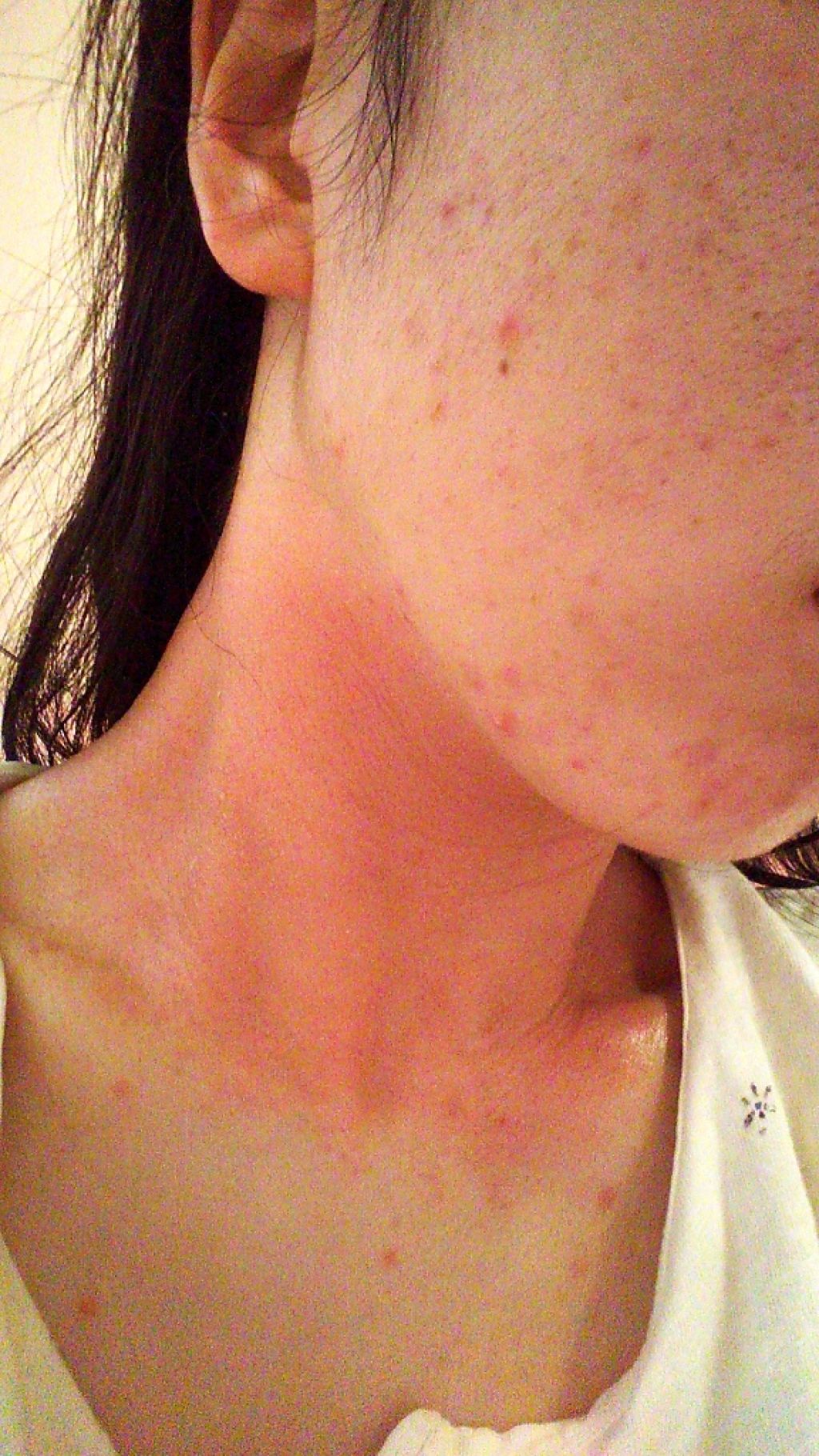 ねこそら on LIPS 「⚠️2.3枚目汚肌注意⚠️処方された薬↓【塗り薬】ヒルドイド0..」(2枚目)