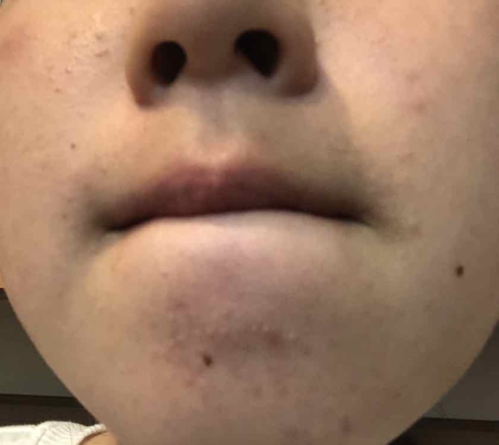 リ コ on LIPS 「汚肌すみません。全然治らないんですもう四年ぐらい居座ってるんで..」(2枚目)