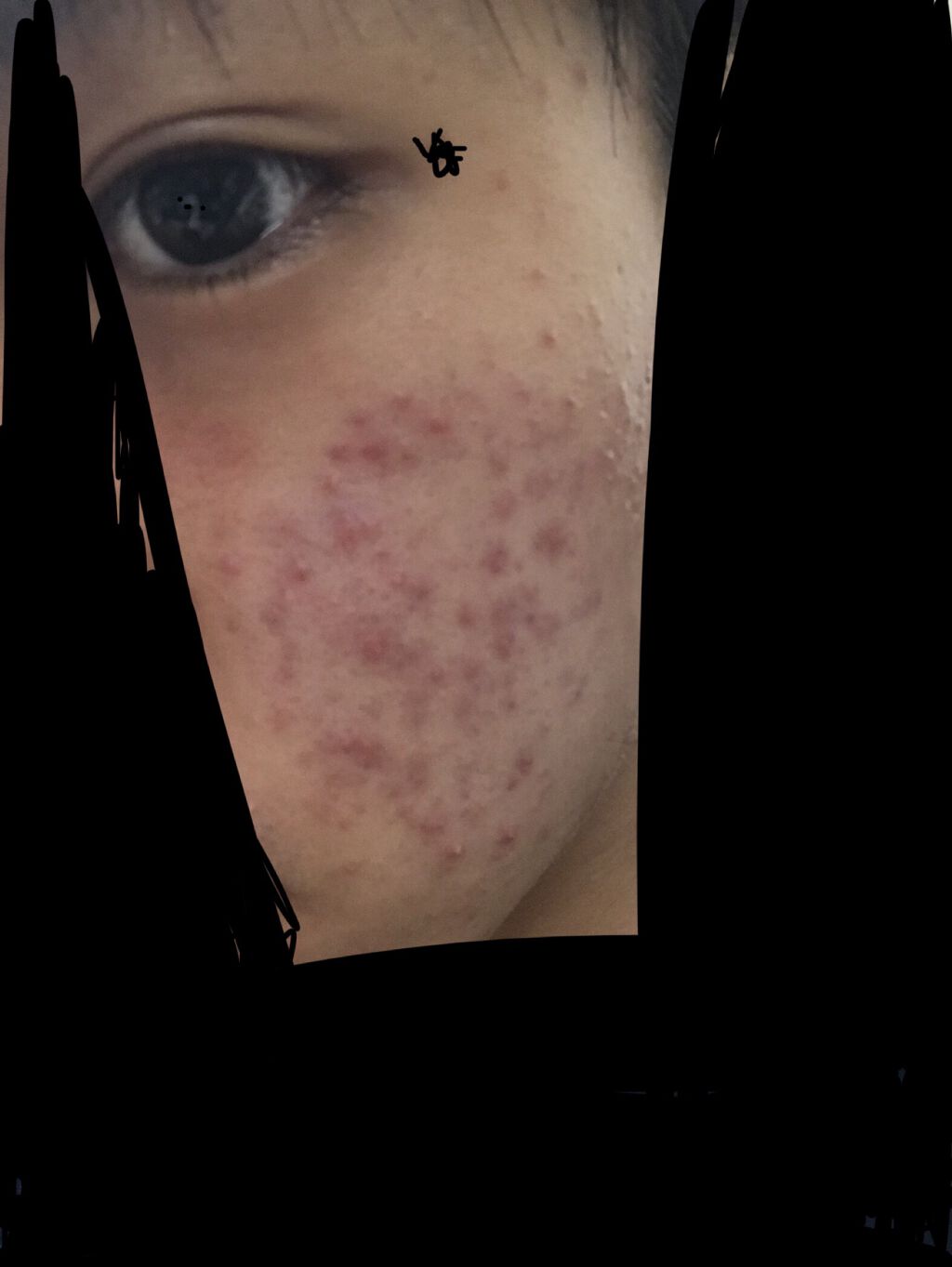 エピデュオゲル/マルホ株式会社/その他を使ったクチコミ（1枚目）