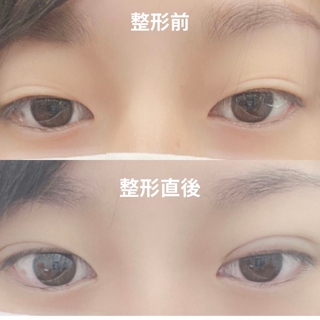 なつ on LIPS 「二重整形(埋没)しました整形記録1閲覧注意2日目〜 右目眼球内..」(1枚目)