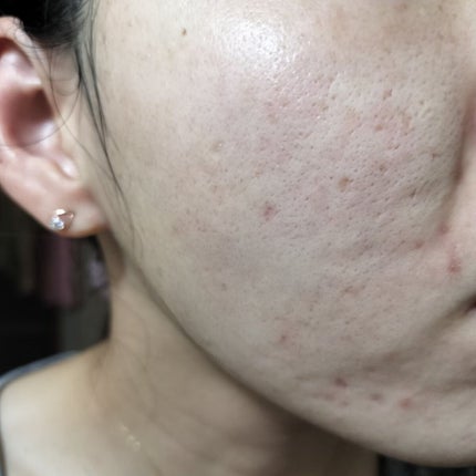 Glucolic Acid 30% Gel Peel/YEOUTH/ピーリングを使ったクチコミ(1枚目)