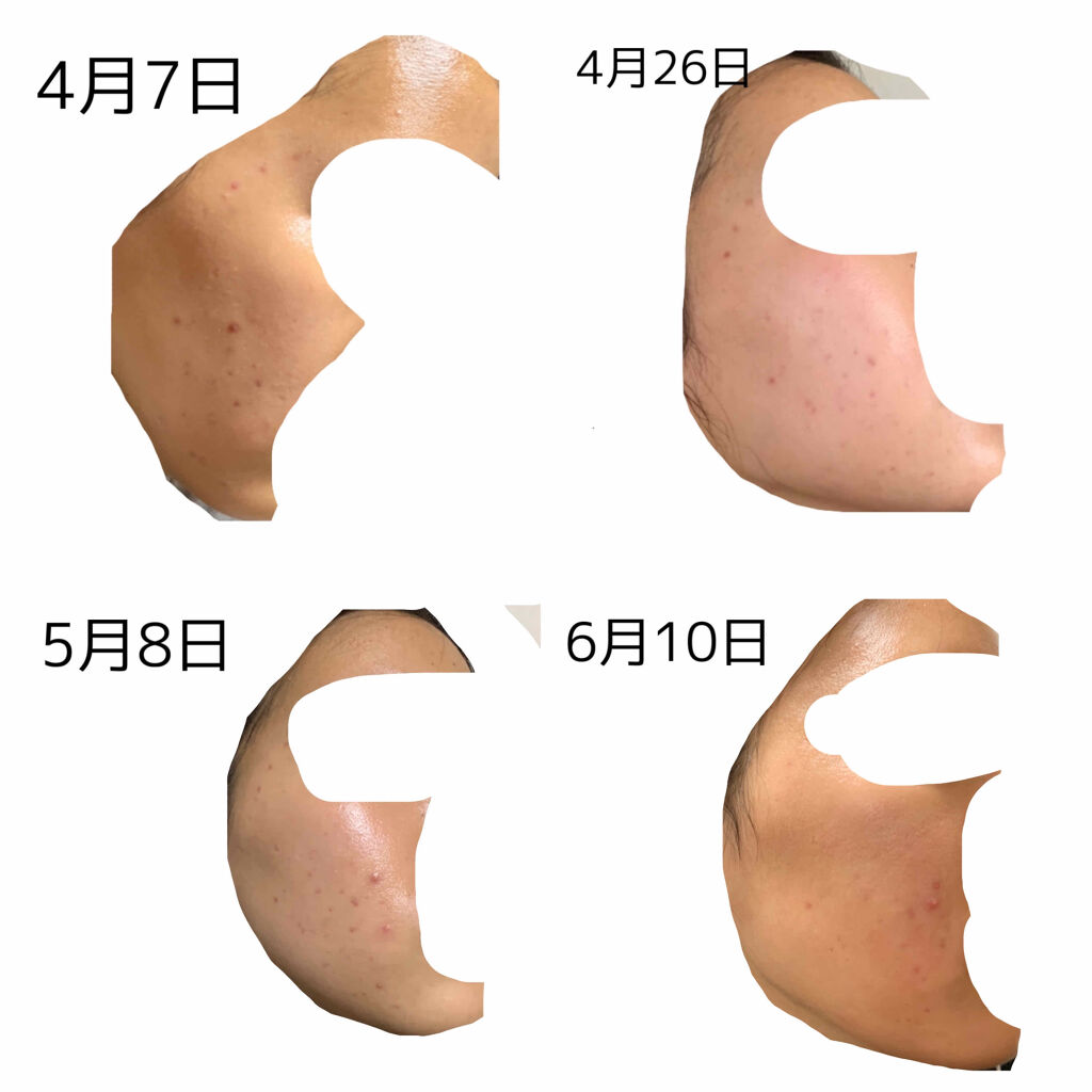 A アクネフォーム/NOV/洗顔フォームを使ったクチコミ（3枚目）