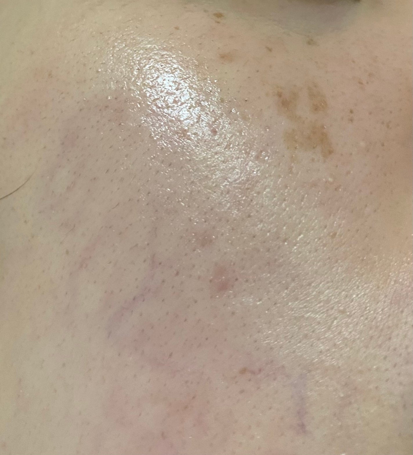 ãã on LIPS ãðã±ãã«ã«ããŒãªã³ã°åŸ10æ¥çšåºŠçµéåŸã®èã§ãçµ¶è³èããŠããã..ãïŒ1æç®ïŒ