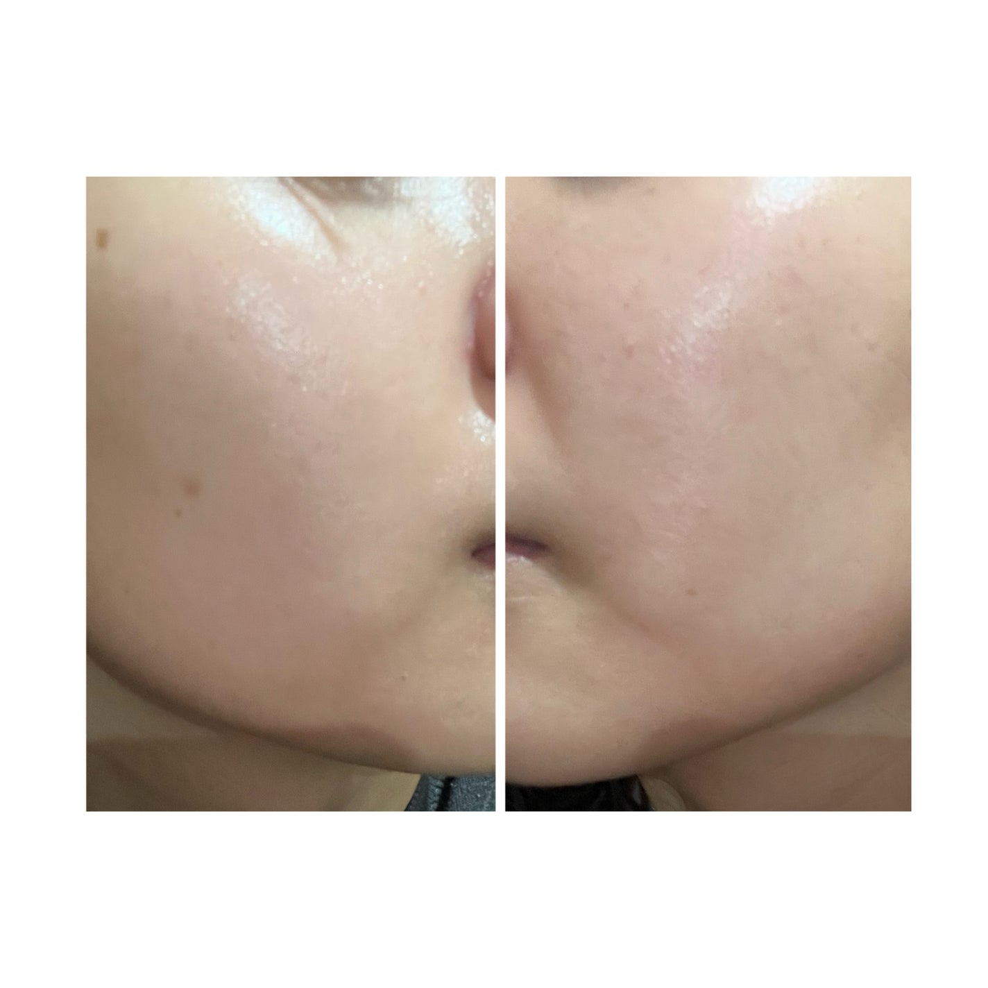 ぽむ on LIPS 「2023.9.13皮膚科に受診 エピデュオとヘパリン処方1枚目..」(1枚目)