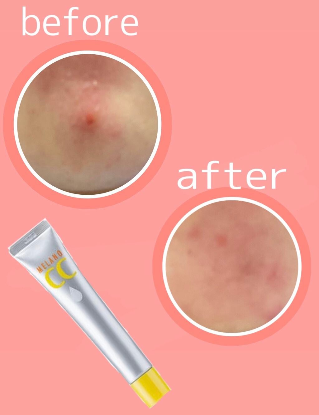 ニキビJK on LIPS 「先週できた顎ニキビの経過です!!結果から言うとメラノCCは、、..」(1枚目)