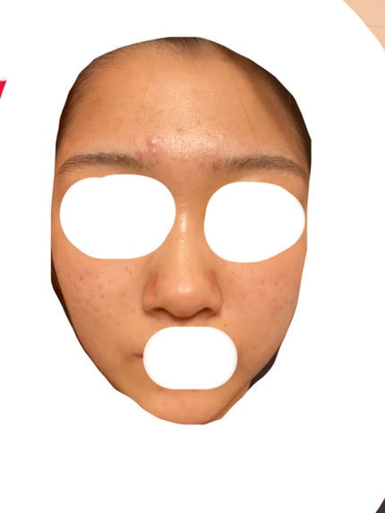 ヒルマイルドクリーム(医薬品)/健栄製薬/その他を使ったクチコミ(1枚目)