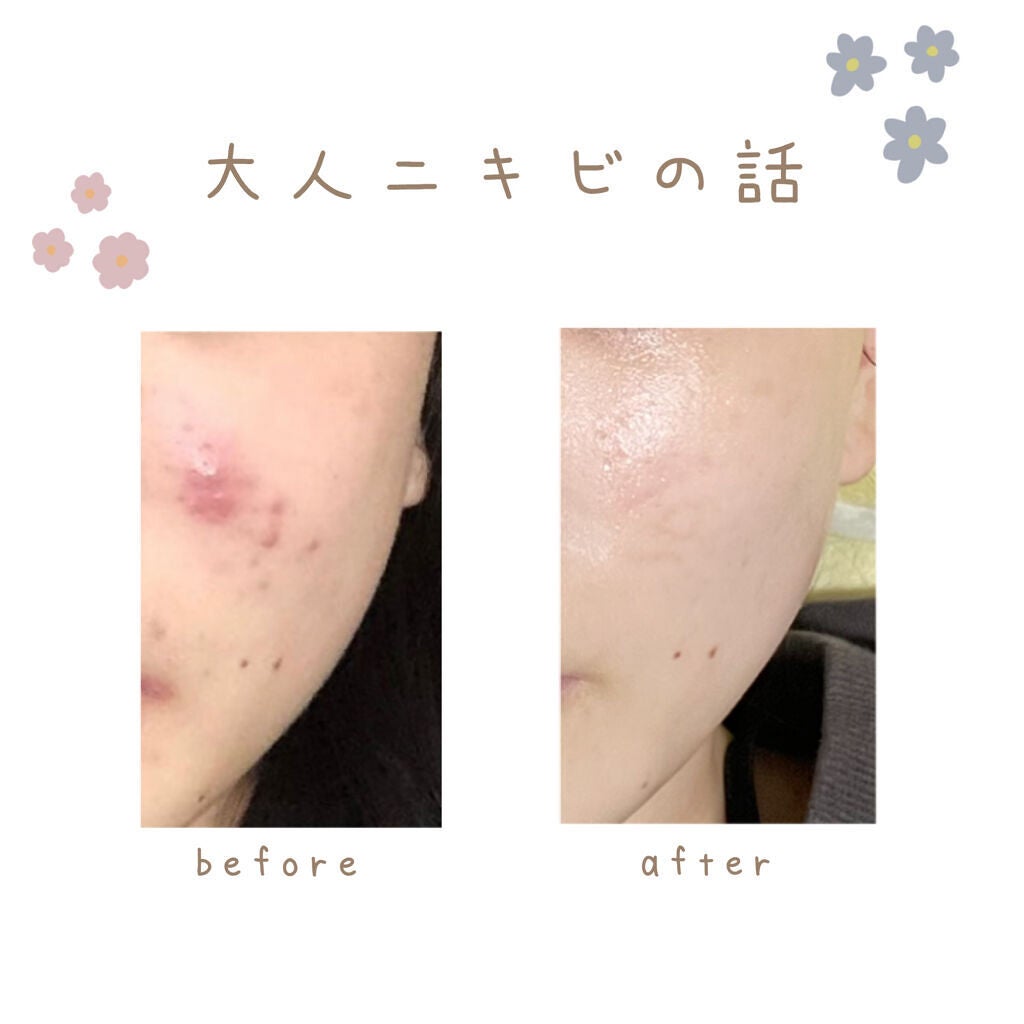 薬用 しみ 集中対策 美容液/メラノCC/美容液を使ったクチコミ(1枚目)