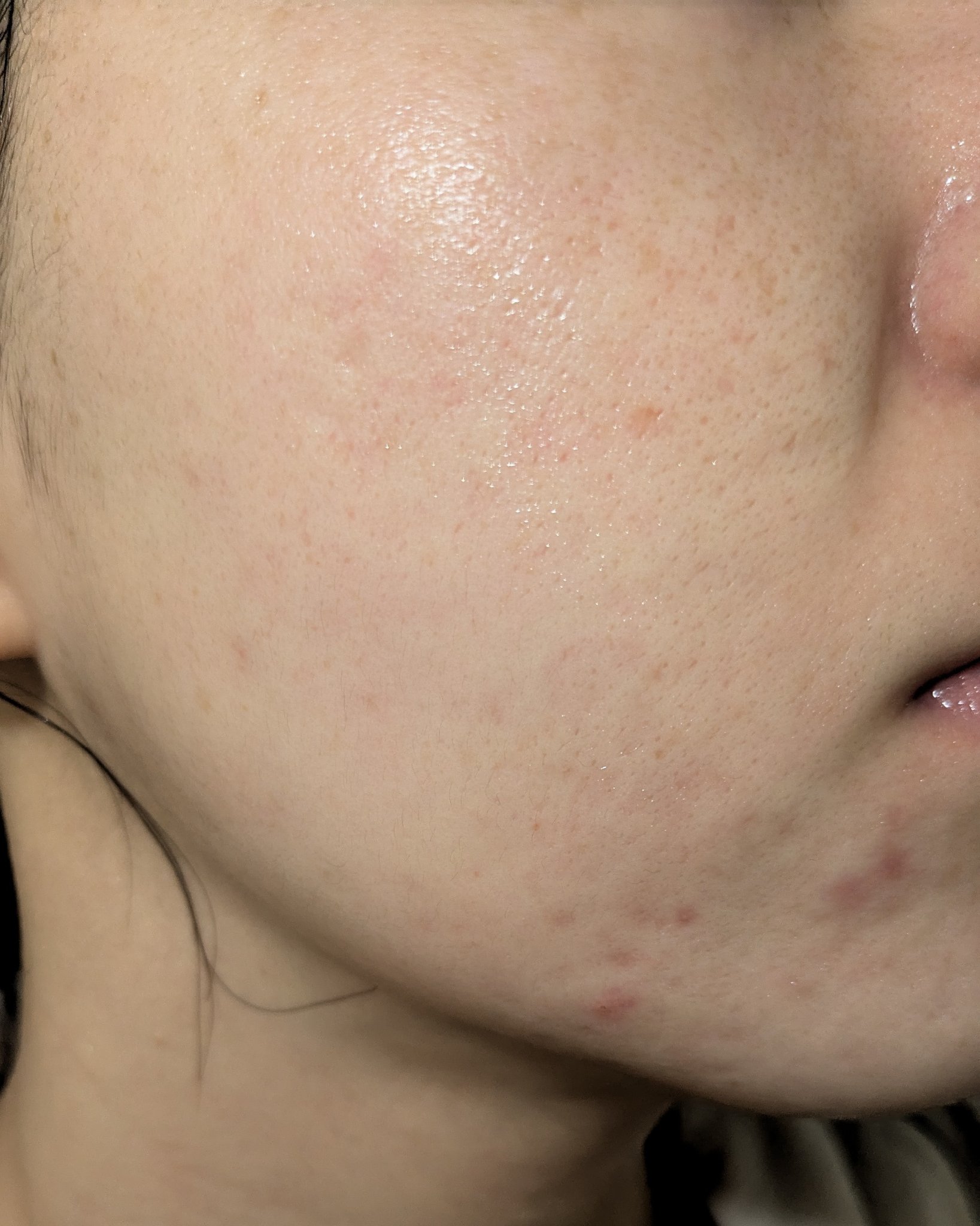 10/26の#汚肌工事録

冬のあごニキビに効く方法あったら教えてください😂

