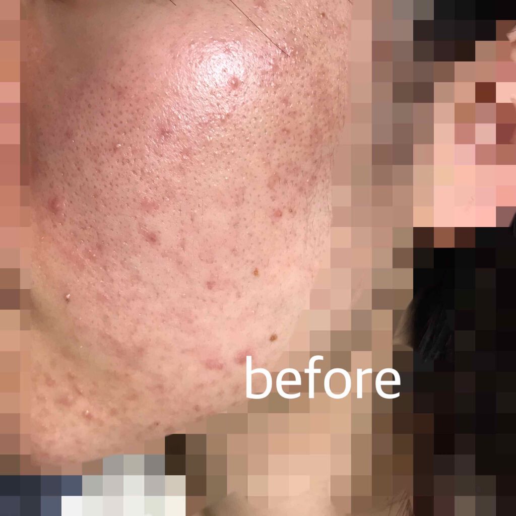 A アクネフォーム/NOV/洗顔フォームを使ったクチコミ(2枚目)