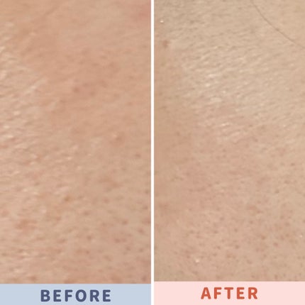 スキンピールバー ティートゥリー/サンソリット/洗顔石鹸を使ったクチコミ(3枚目)