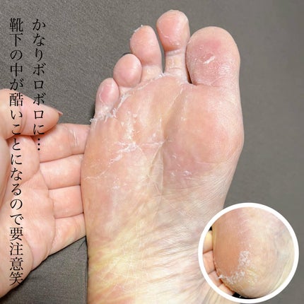 あしやすめ 足裏角質ケアパック/鎌倉ライフ/レッグ・フットケアを使ったクチコミ(8枚目)