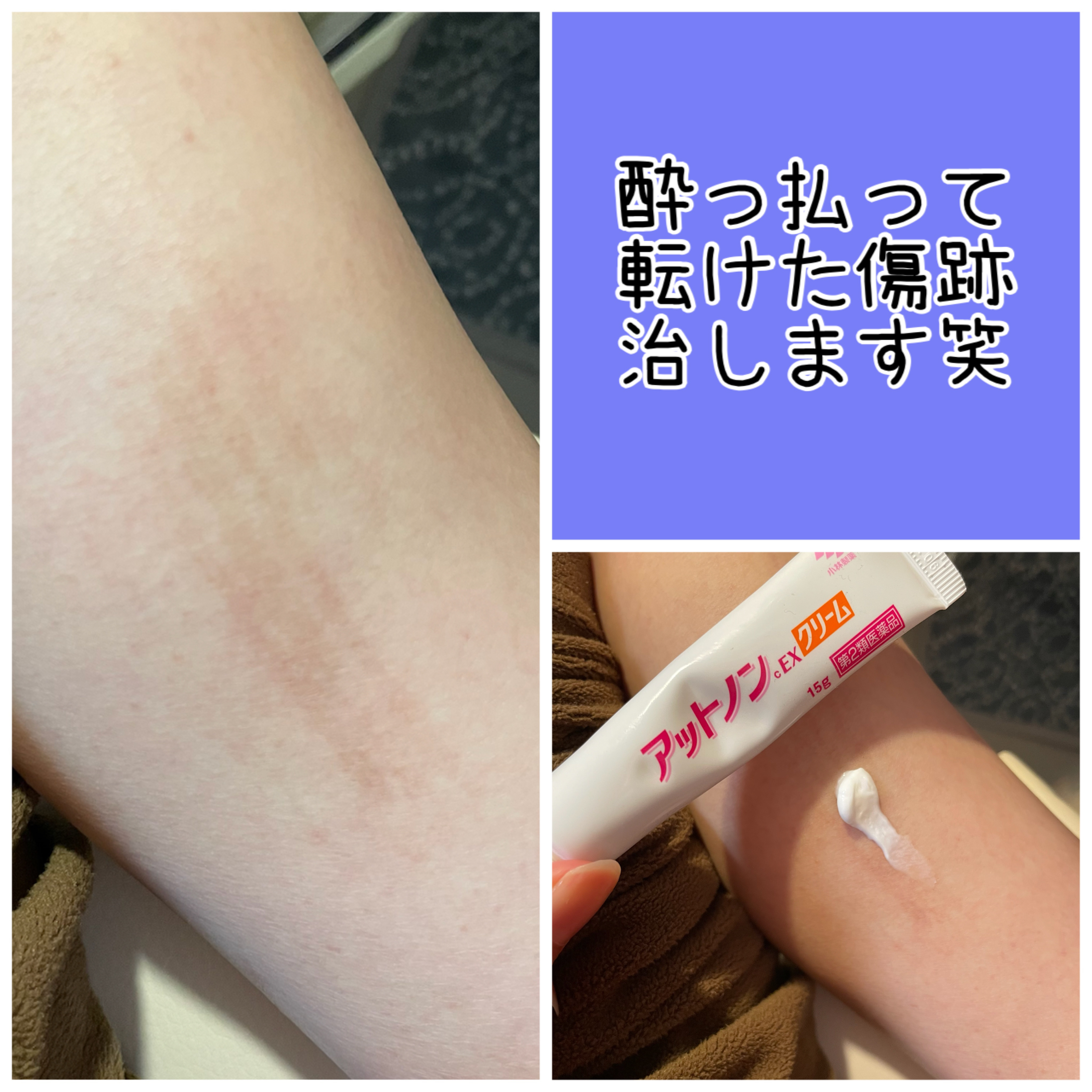 アットノンEX クリーム(医薬品)/アットノン/その他を使ったクチコミ（1枚目）