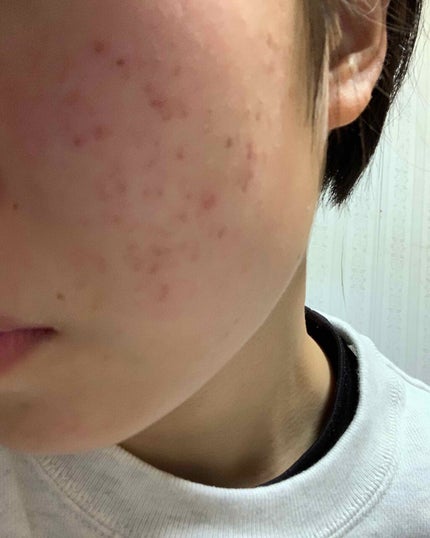 スキンケア洗顔料 薬用アクネケア/ビオレ/洗顔フォームを使ったクチコミ(2枚目)