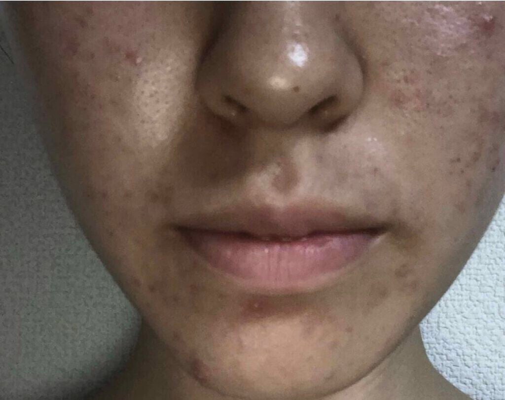 ノブ A アクネソープ/NOV/洗顔石鹸を使ったクチコミ(2枚目)