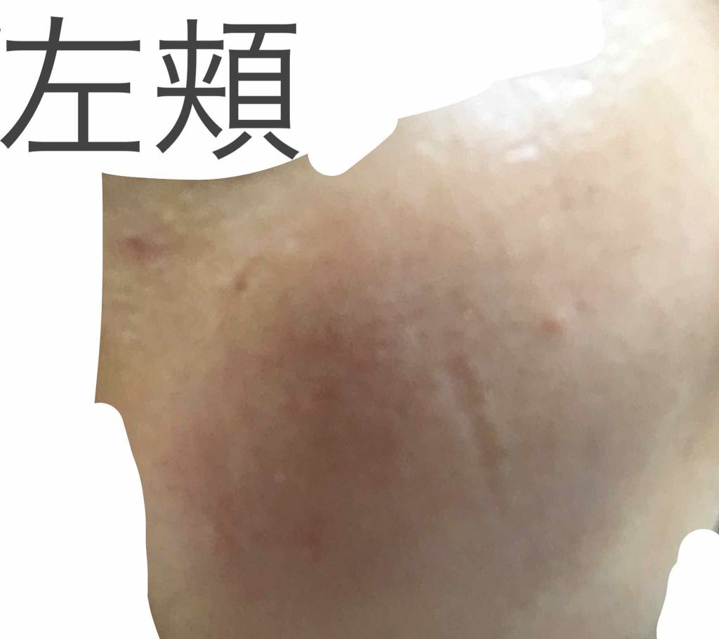 ノブ A アクネソープ/NOV/洗顔石鹸を使ったクチコミ(4枚目)